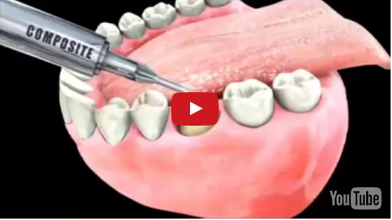 What Are Dental Crowns And Dental Bridges Dayton Dental
